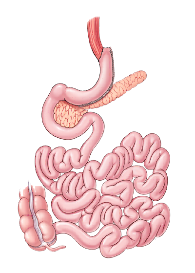 gastric_sleeve_ASMBS Gastric Sleeve diagram