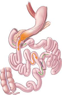 DudodenalSwitch Duodenal Switch diagram
